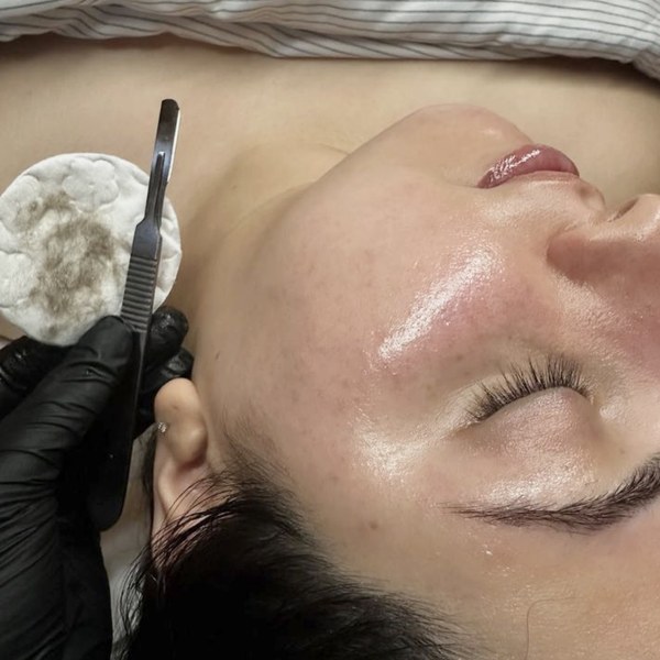 Derma planning Treatment - 30 min